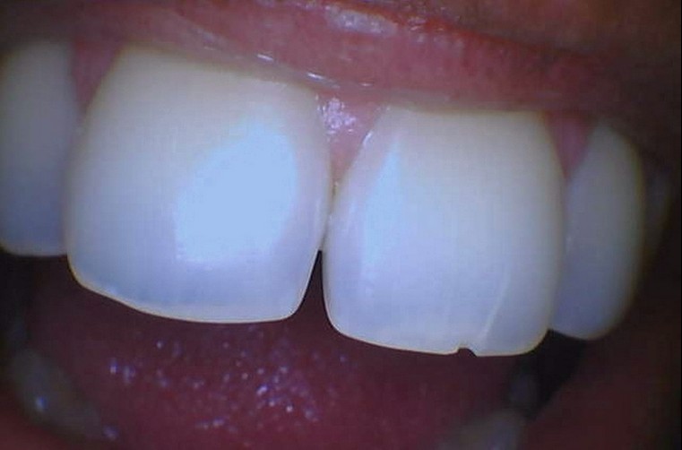chipped tooth