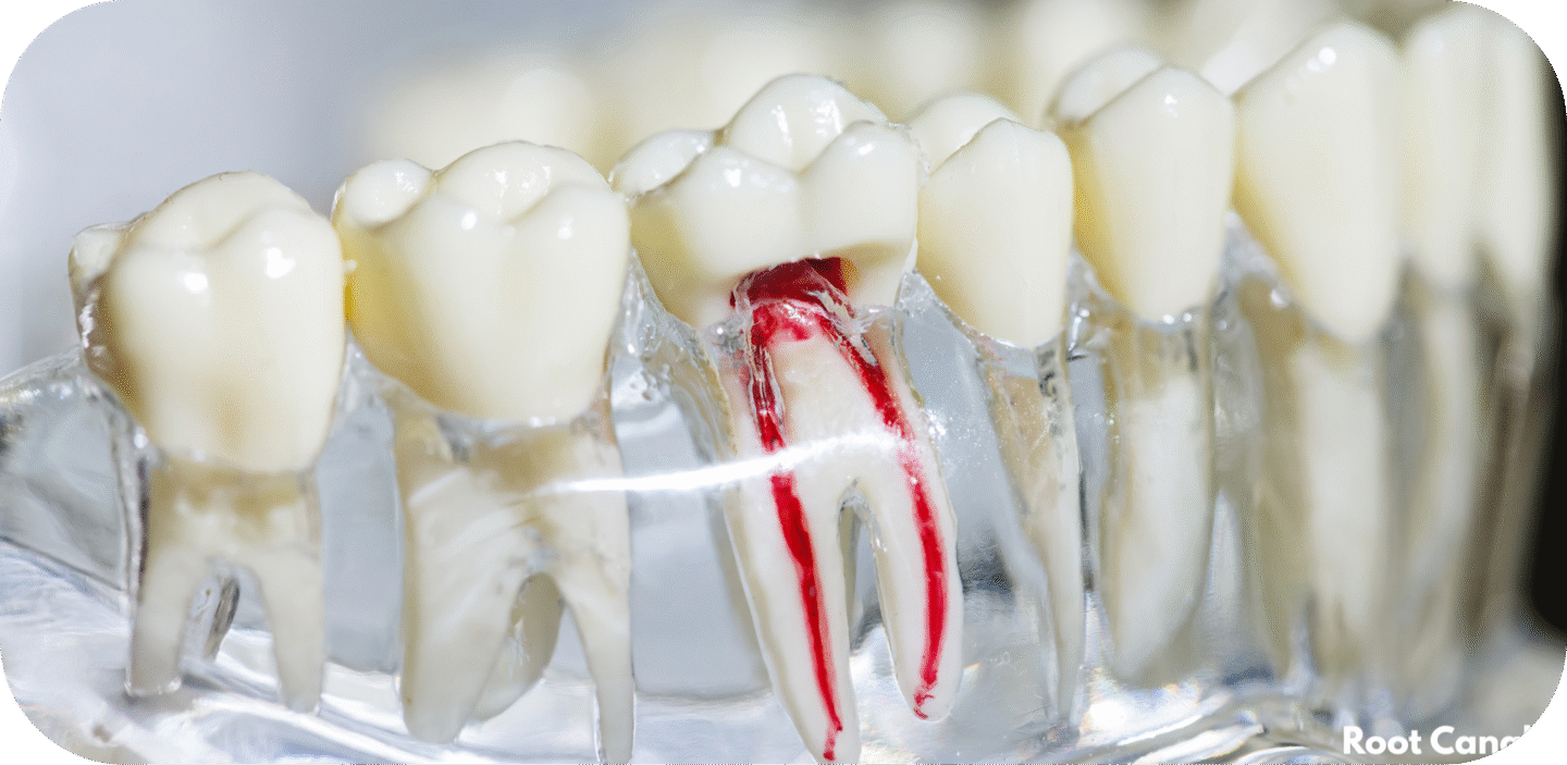 root canals
